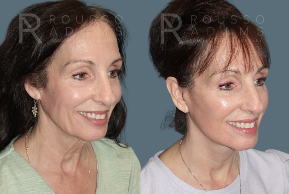 Deep Plane Facelift <span class=small>By Dr. Austin Adams</span> Before & After Gallery - Patient 212388 - Image 3