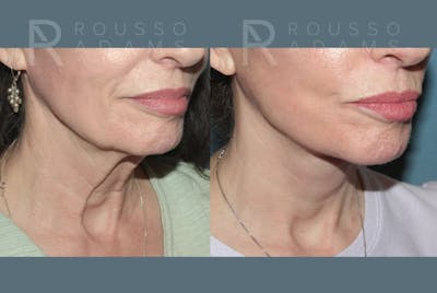 Deep Plane Facelift Before & After Gallery - Patient 212388 - Image 4