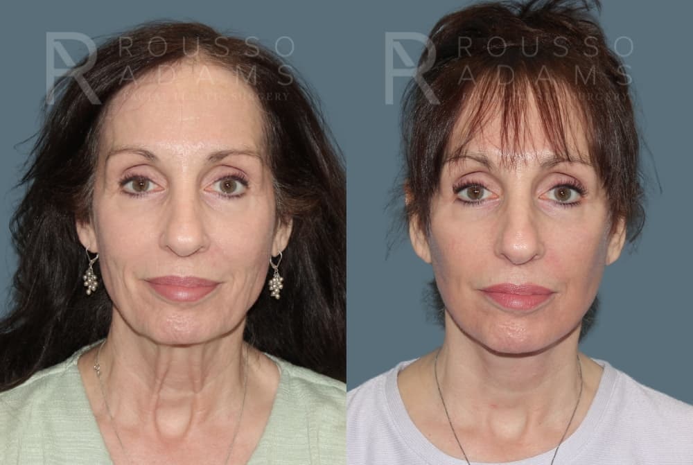 Deep Plane Facelift Before & After Gallery - Patient 212388 - Image 5