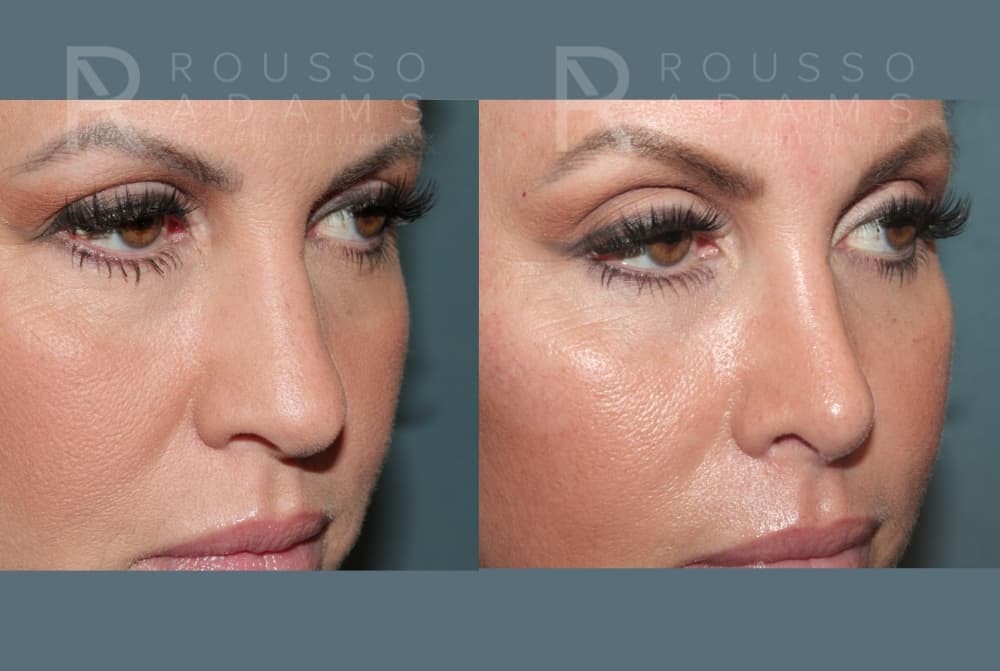 Rhinoplasty Before & After Gallery - Patient 406348 - Image 5