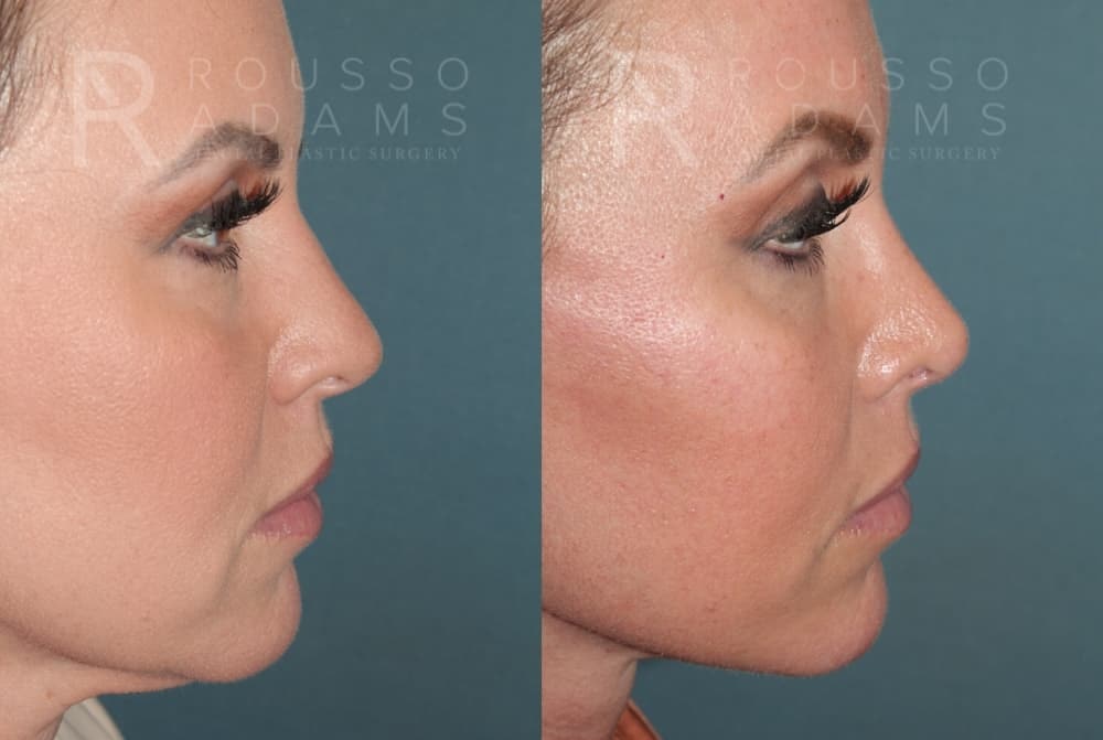 Rhinoplasty Before & After Gallery - Patient 406348 - Image 4