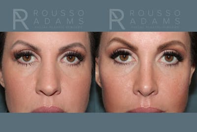 Rhinoplasty Before & After Gallery - Patient 406348 - Image 6