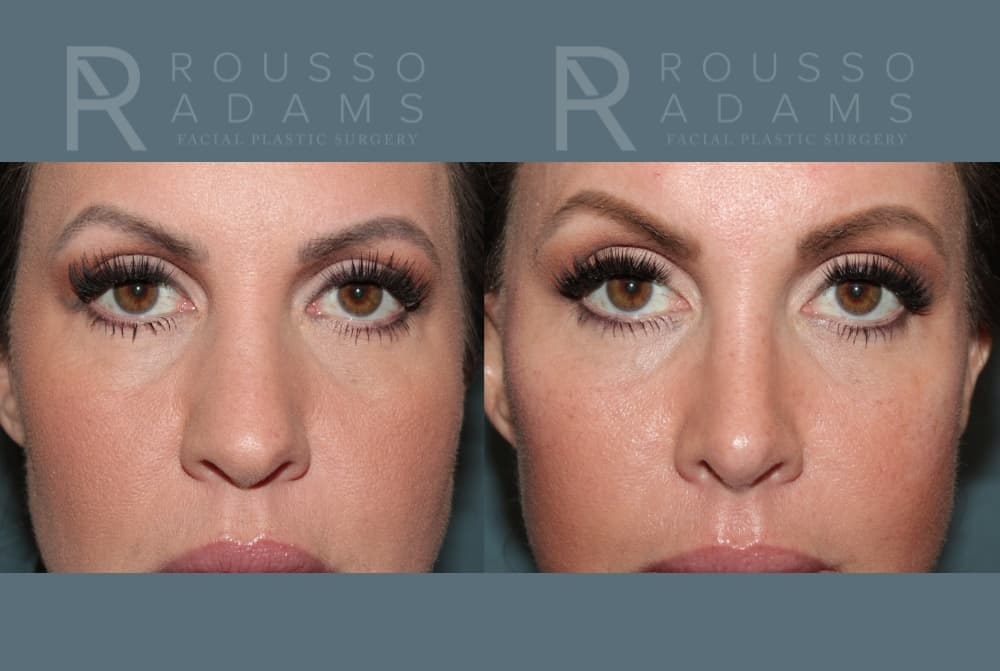 Rhinoplasty Before & After Gallery - Patient 406348 - Image 6