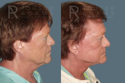 Male Facelift Before & After Gallery - Patient 255155 - Image 2