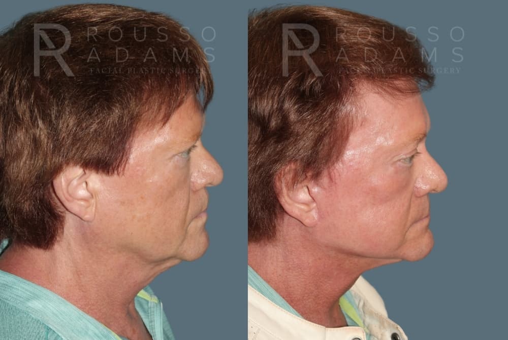 Deep Plane Facelift Before & After Gallery - Patient 335579 - Image 2