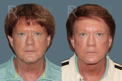 Skin Rejuvenation Before & After Gallery - Patient 105508 - Image 4