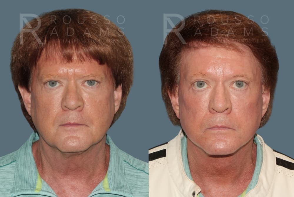 Deep Plane Facelift Before & After Gallery - Patient 335579 - Image 3