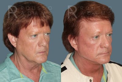Deep Plane Facelift Before & After Gallery - Patient 335579 - Image 1