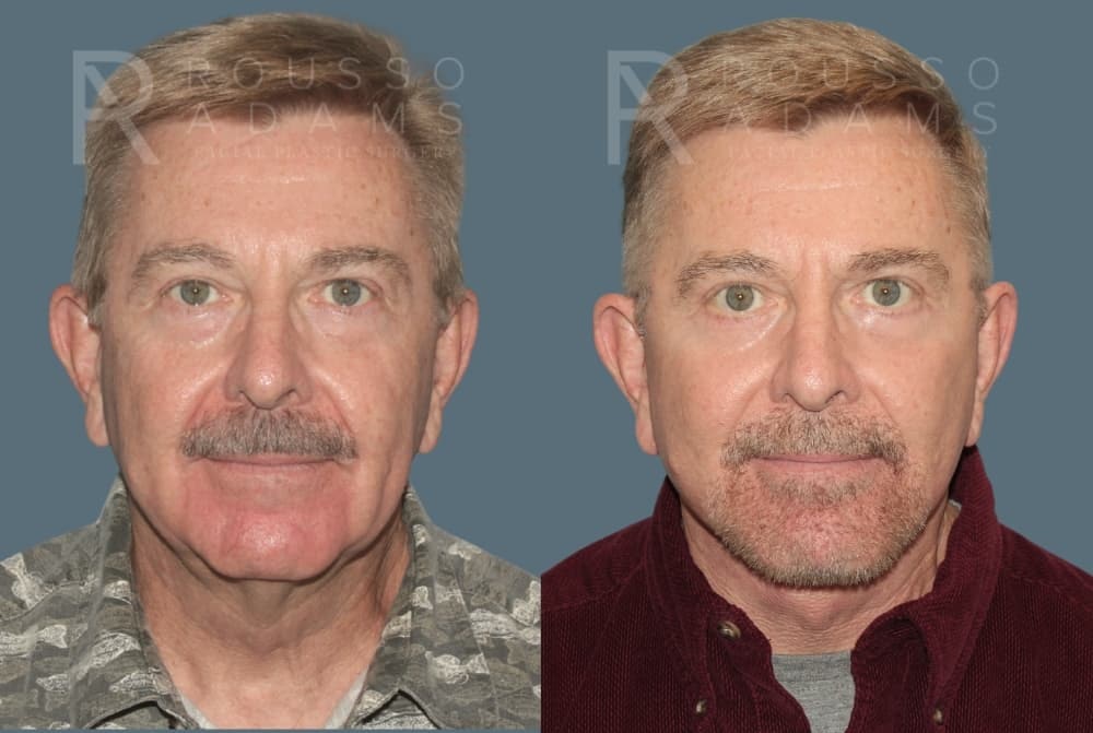 Deep Plane Facelift Before & After Gallery - Patient 239636 - Image 3