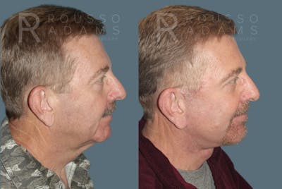 Male Facelift Before & After Gallery - Patient 688044 - Image 2