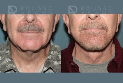 Deep Plane Facelift <span class=small>By Dr. Austin Adams</span> Before & After Gallery - Patient 239636 - Image 4