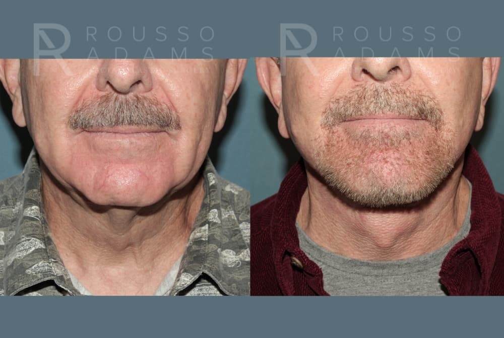 Deep Plane Facelift <span class=small>By Dr. Austin Adams</span> Before & After Gallery - Patient 239636 - Image 4