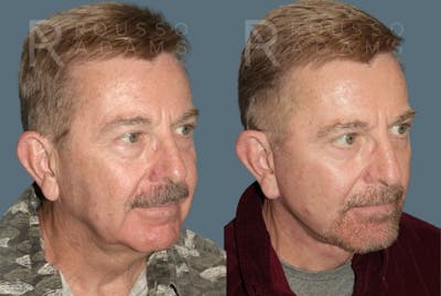 Male Facelift Before & After Gallery - Patient 688044 - Image 1
