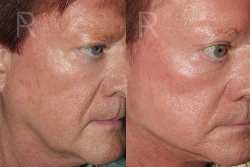 Skin Rejuvenation Before & After Gallery - Patient 105508 - Image 1