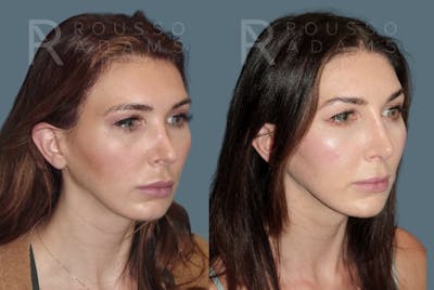 Revision Rhinoplasty <span class=small>By Dr. Daniel Rousso</span> Before & After Gallery - Patient 185790 - Image 1