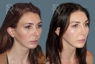 Revision Rhinoplasty Before & After Gallery - Patient 185790 - Image 1