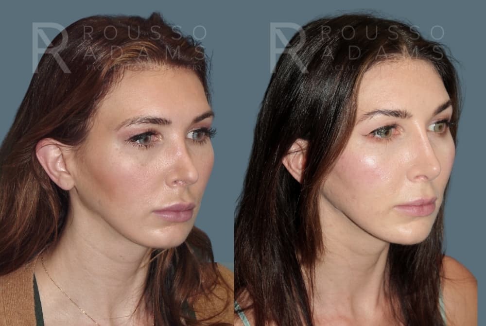 Revision Rhinoplasty <span class=small>By Dr. Daniel Rousso</span> Before & After Gallery - Patient 185790 - Image 1