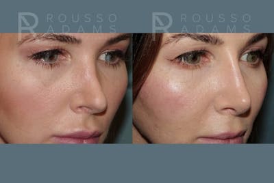 Revision Rhinoplasty <span class=small>By Dr. Daniel Rousso</span> Before & After Gallery - Patient 185790 - Image 2
