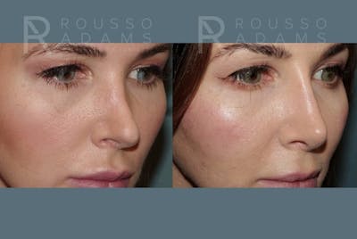 Revision Rhinoplasty Before & After Gallery - Patient 185790 - Image 2