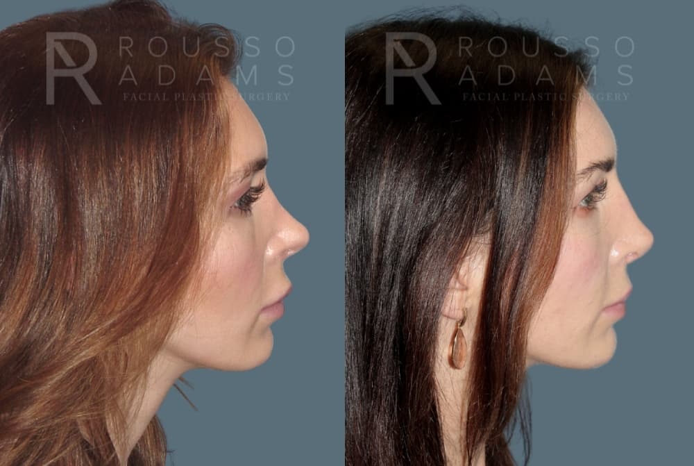 Revision Rhinoplasty <span class=small>By Dr. Daniel Rousso</span> Before & After Gallery - Patient 185790 - Image 3