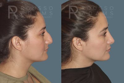 Rhinoplasty <span class=small>By Dr. Daniel Rousso</span> Before & After Gallery - Patient 406611 - Image 1