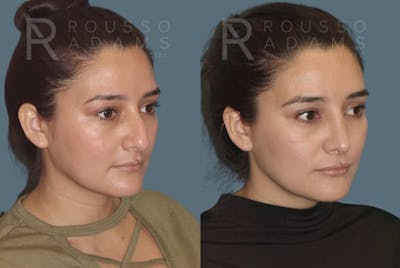 Rhinoplasty <span class=small>By Dr. Daniel Rousso</span> Before & After Gallery - Patient 406611 - Image 2