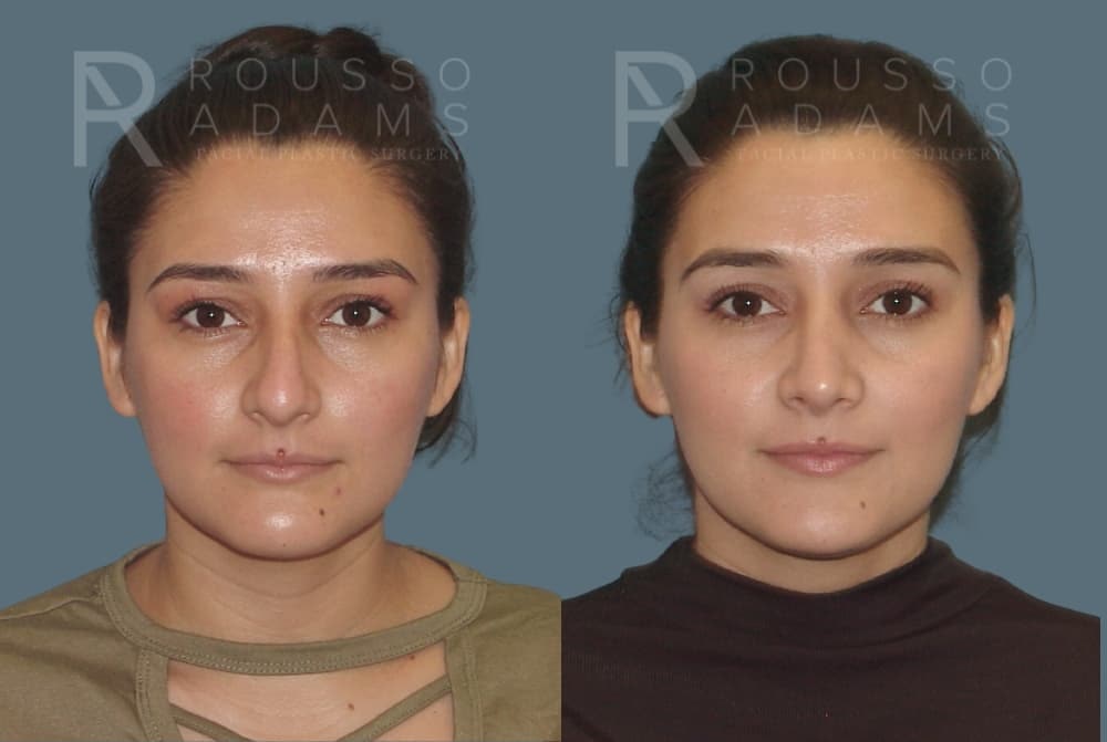 Rhinoplasty <span class=small>By Dr. Daniel Rousso</span> Before & After Gallery - Patient 406611 - Image 3
