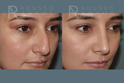 Rhinoplasty Before & After Gallery - Patient 406611 - Image 4