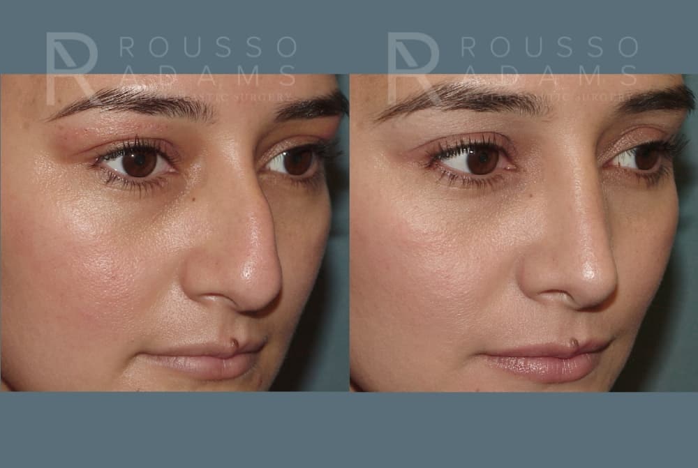 Rhinoplasty <span class=small>By Dr. Daniel Rousso</span> Before & After Gallery - Patient 406611 - Image 4