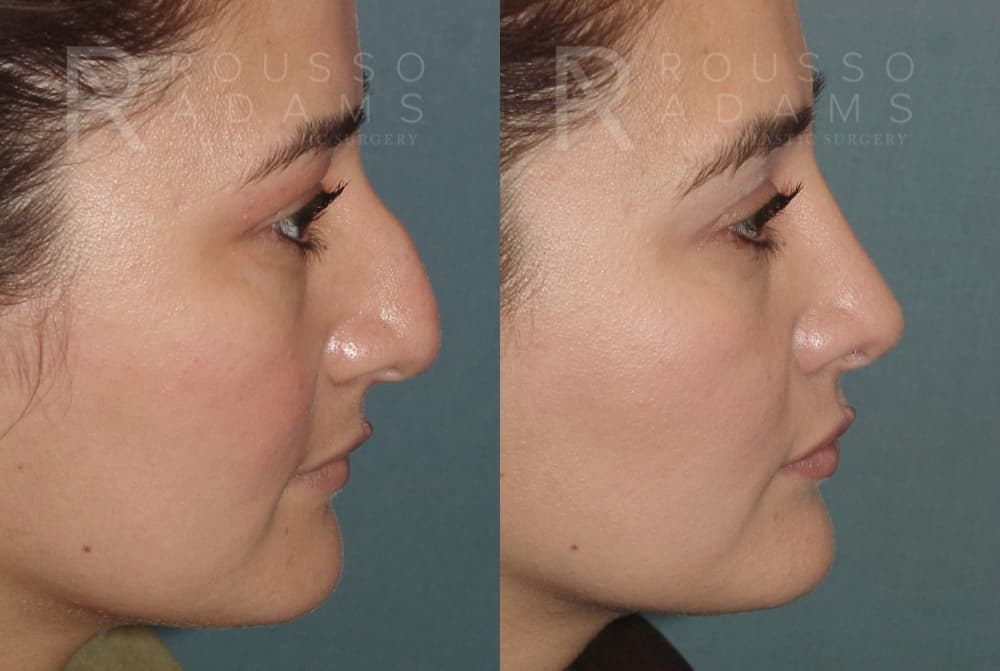 Rhinoplasty <span class=small>By Dr. Daniel Rousso</span> Before & After Gallery - Patient 406611 - Image 5