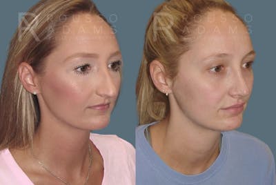 Rhinoplasty <span class=small>By Dr. Daniel Rousso</span> Before & After Gallery - Patient 349982 - Image 2