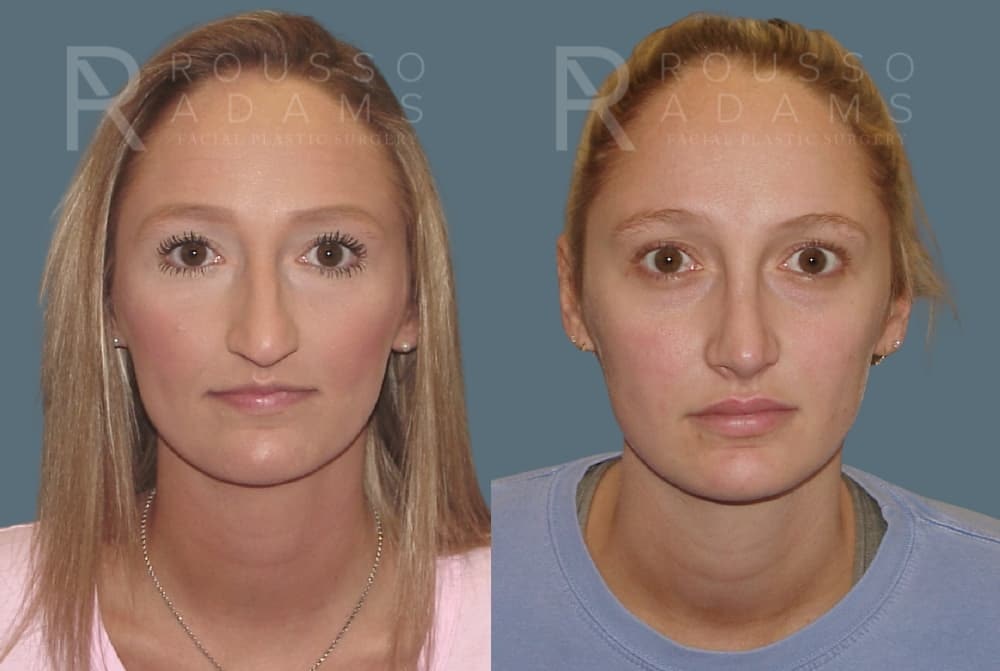 Rhinoplasty <span class=small>By Dr. Daniel Rousso</span> Before & After Gallery - Patient 349982 - Image 3