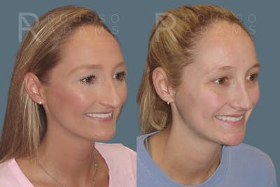 Rhinoplasty <span class=small>By Dr. Daniel Rousso</span> Before & After Gallery - Patient 349982 - Image 4