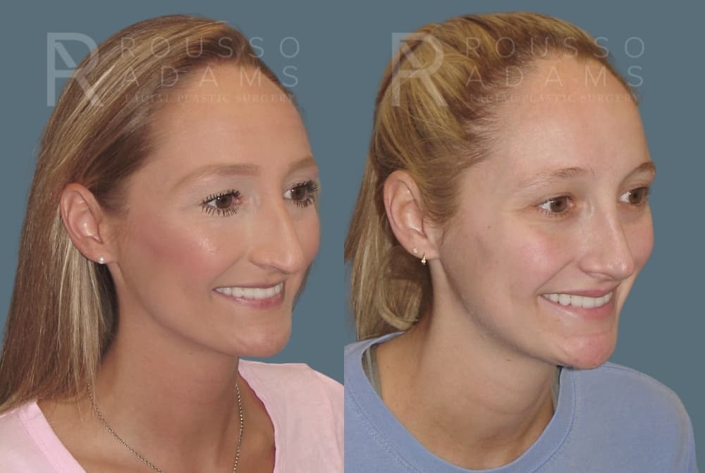 Rhinoplasty <span class=small>By Dr. Daniel Rousso</span> Before & After Gallery - Patient 349982 - Image 4