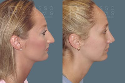 Rhinoplasty <span class=small>By Dr. Daniel Rousso</span> Before & After Gallery - Patient 349982 - Image 1