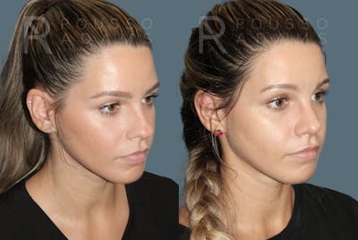 Rhinoplasty <span class=small>By Dr. Daniel Rousso</span> Before & After Gallery - Patient 148748 - Image 2