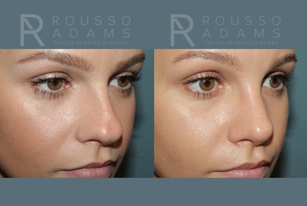 Rhinoplasty <span class=small>By Dr. Daniel Rousso</span> Before & After Gallery - Patient 148748 - Image 3