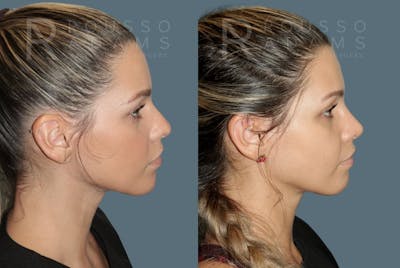 Rhinoplasty <span class=small>By Dr. Daniel Rousso</span> Before & After Gallery - Patient 148748 - Image 1