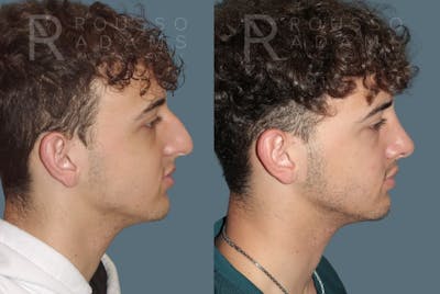 Rhinoplasty <span class=small>By Dr. Daniel Rousso</span> Before & After Gallery - Patient 247066 - Image 1