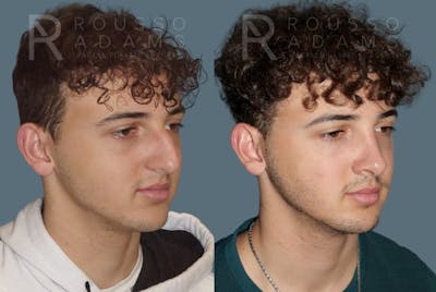 Rhinoplasty <span class=small>By Dr. Daniel Rousso</span> Before & After Gallery - Patient 247066 - Image 2