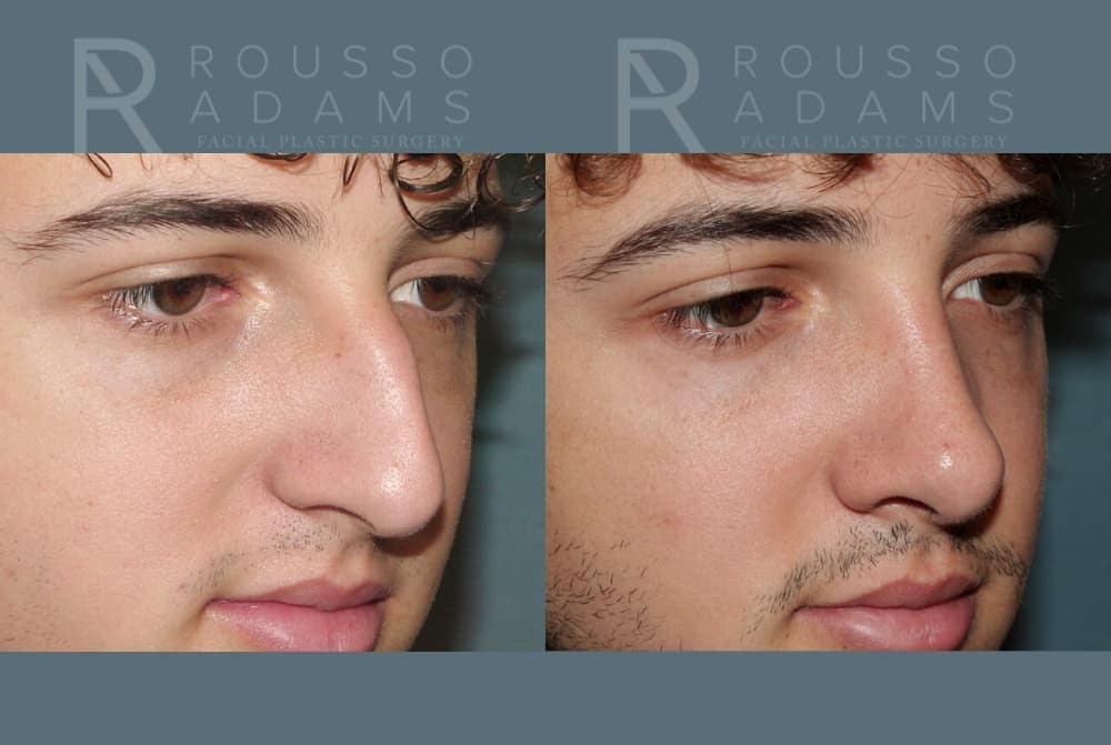 Rhinoplasty <span class=small>By Dr. Daniel Rousso</span> Before & After Gallery - Patient 247066 - Image 3