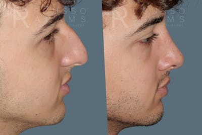Rhinoplasty <span class=small>By Dr. Daniel Rousso</span> Before & After Gallery - Patient 247066 - Image 4