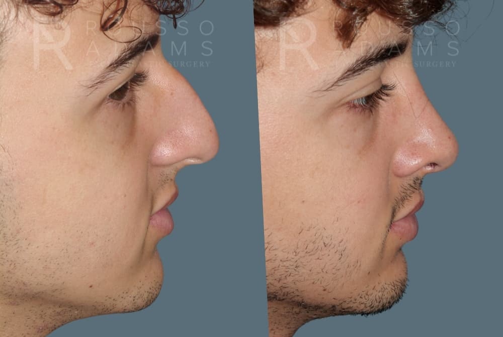Rhinoplasty <span class=small>By Dr. Daniel Rousso</span> Before & After Gallery - Patient 247066 - Image 4