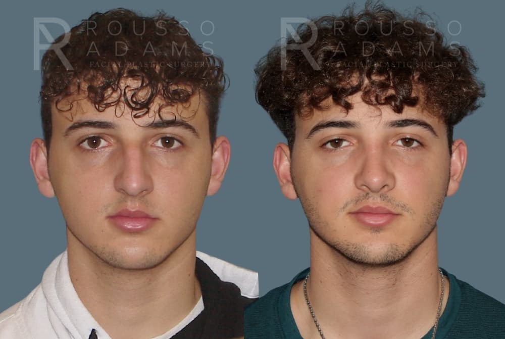 Rhinoplasty <span class=small>By Dr. Daniel Rousso</span> Before & After Gallery - Patient 247066 - Image 5