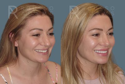 Rhinoplasty <span class=small>By Dr. Daniel Rousso</span> Before & After Gallery - Patient 208015 - Image 2