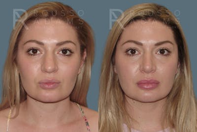 Rhinoplasty <span class=small>By Dr. Daniel Rousso</span> Before & After Gallery - Patient 208015 - Image 1