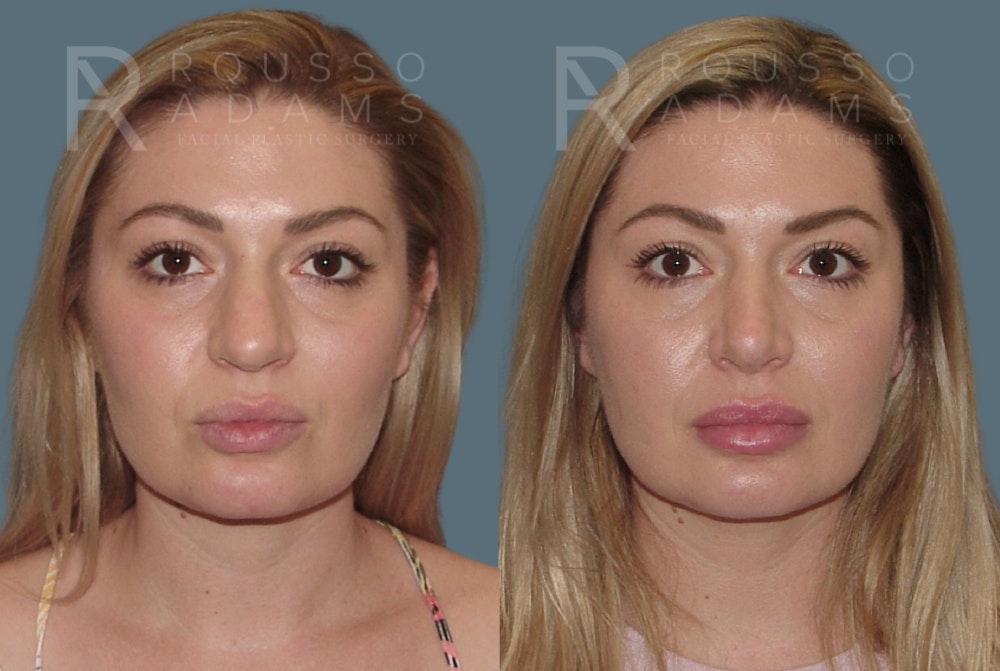 Rhinoplasty <span class=small>By Dr. Daniel Rousso</span> Before & After Gallery - Patient 208015 - Image 3
