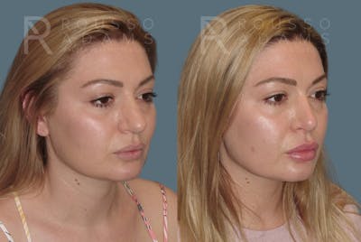 Rhinoplasty <span class=small>By Dr. Daniel Rousso</span> Before & After Gallery - Patient 208015 - Image 4
