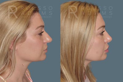 Rhinoplasty <span class=small>By Dr. Daniel Rousso</span> Before & After Gallery - Patient 208015 - Image 1