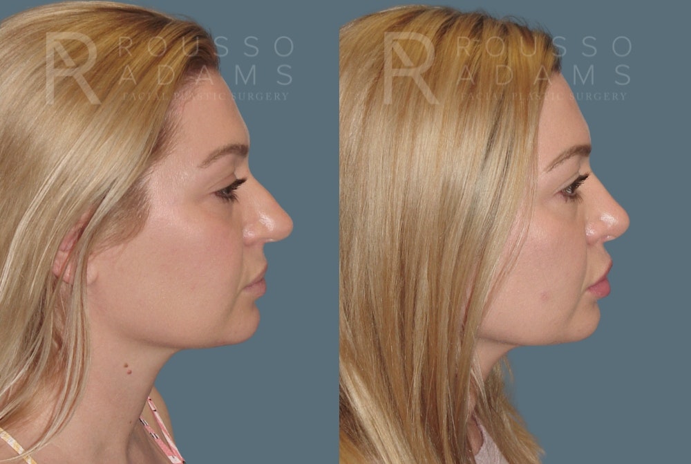 Rhinoplasty <span class=small>By Dr. Daniel Rousso</span> Before & After Gallery - Patient 208015 - Image 1